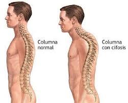 cifosis Hipercifosis, chepa o joroba en adolescentes  