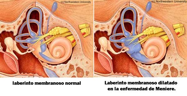 Remedios caseros para la enfermedad de Meniere