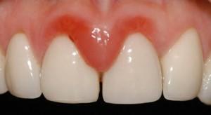 La gingivitis manipula el sistema inmunológico La gingivitis manipula el sistema inmunológico