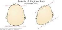 La plagiocefalia postural del bebé es cada vez más frecuente porque los padres son unos cagados para cambiarlos de posición