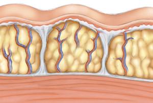 ¿QUÉ ES LA CELULITIS? ¿PORQUÉ EL HOMBRE TIENE MENOS GRASA QUE LA MUJER? celulitis
