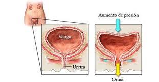 Que es la incontinencia urinaria incontinencia urinaria