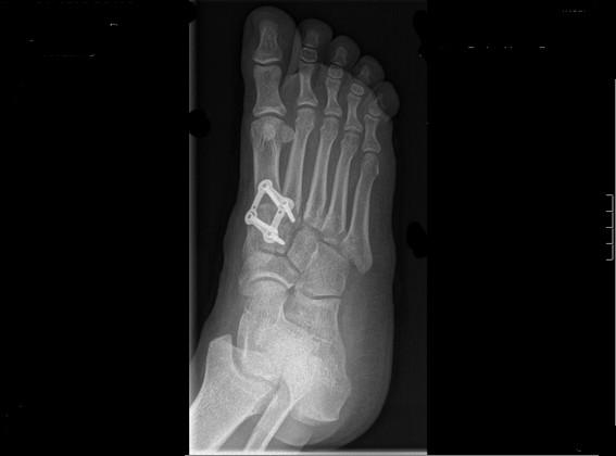 LESION DE LISFRANC