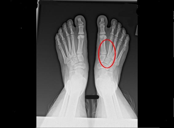 LESION DE LISFRANC