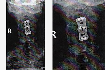 radiografias-cuello-sylvester-stallone