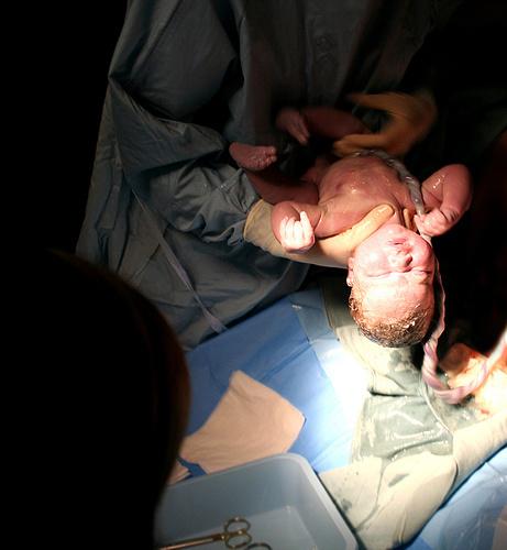 ¿Deberían los médicos esperar un poco más para cortar el cordón umbilical? cordón umbilical