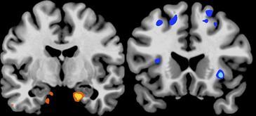 La falta de sueño aumenta el deseo por alimentos ricos en calorías La falta de sueño aumenta el deseo por alimentos ricos en calorías