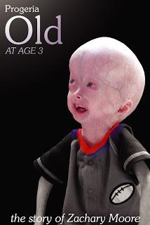 Progeria: niños ancianos con una esperanza