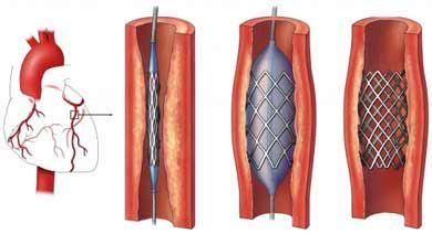 Se cumplen 25 años de la creacion del stent, un invento argentino.