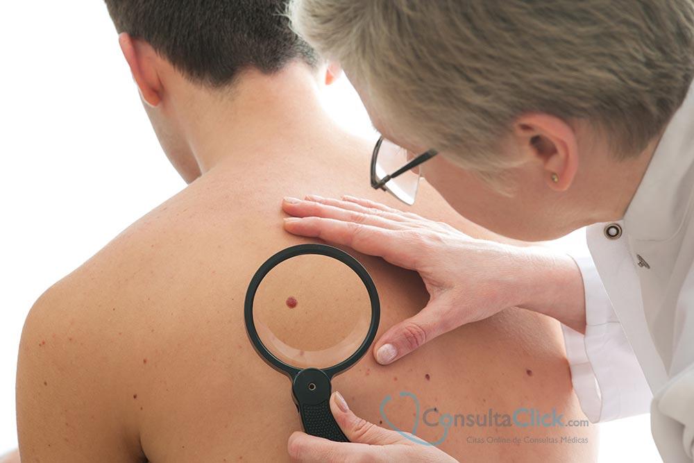Cáncer de piel: melanoma