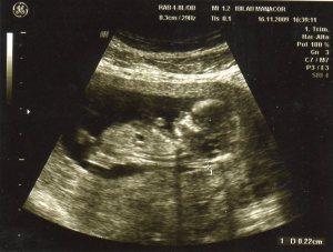 La nueva ley del aborto y el Sr. Gallardón… eco