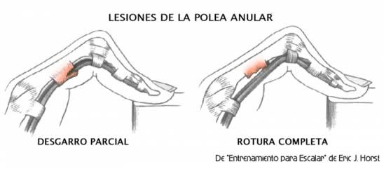 Lesiones de dedos