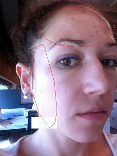 Brote Acneico, Ayuda !!! Brote Acneico, Ayuda !!!