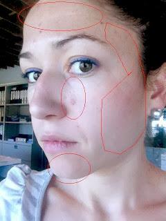 Brote Acneico, Ayuda !!! Brote Acneico, Ayuda !!!