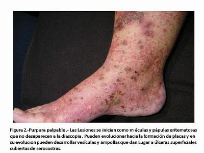 Purpura palpable Purpura palpable