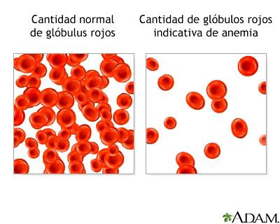 globulos_en_anemia