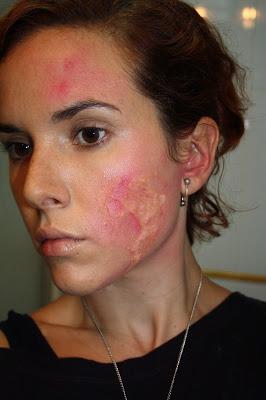 IDEAS PARA HALLOWEEN: QUEMADURAS IDEAS PARA HALLOWEEN: QUEMADURAS