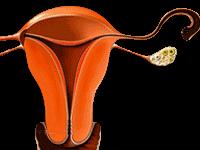 Salud y funcionamiento del útero