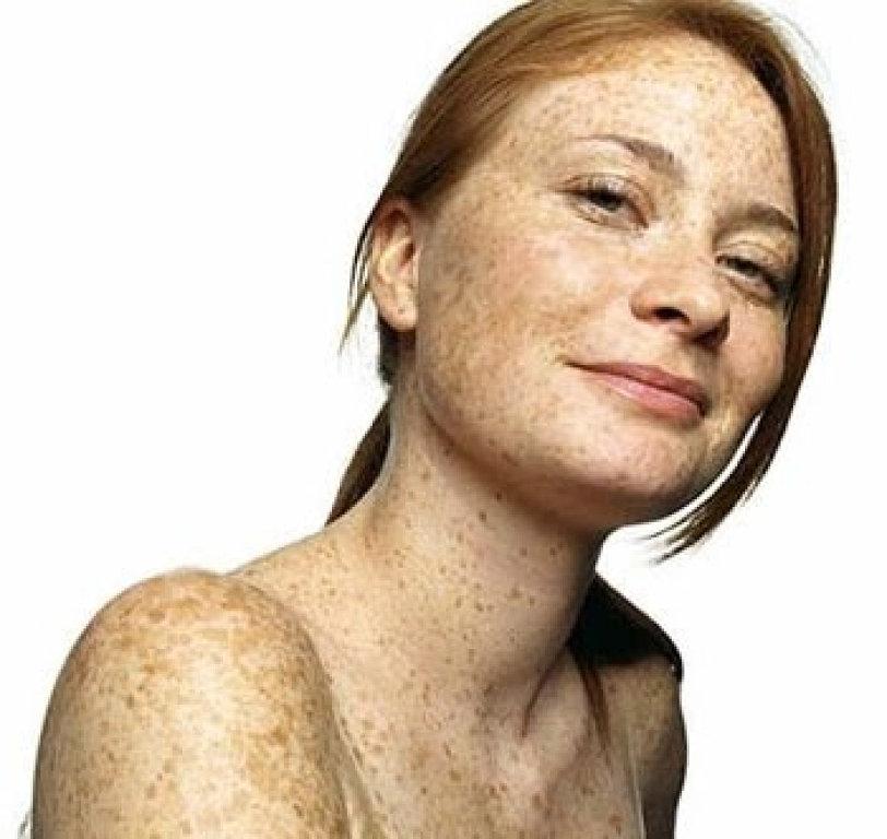 La crema que elimina las manchas de la piel y atenúa las pecas La crema que elimina las manchas de la piel y atenúa las pecas