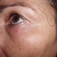 Summum Correction Gotas Cumlaude. manchas oscuras