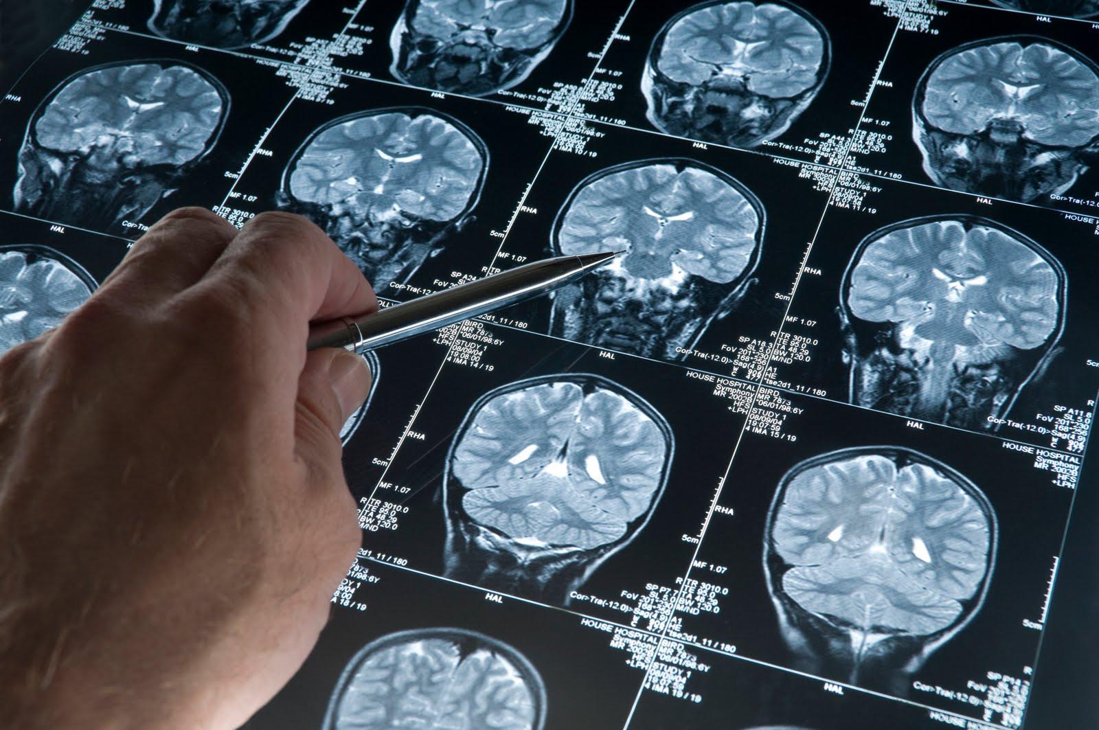 Científicos sugieren que la tecnología láser podrá curar el Alzheimer