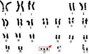 cariotipo trisomia 21