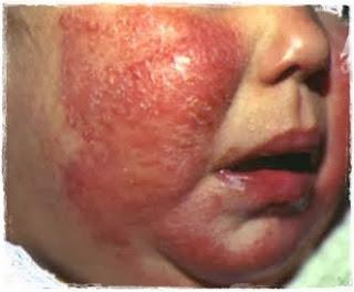 La dermatitis atópica en el niño