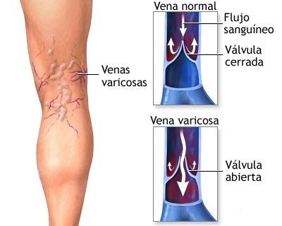 SmartSalus y las varices