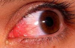 Recomendaciones en la aparición de pequeños Derrames Oculares