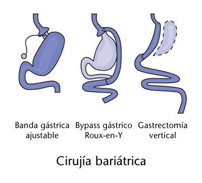 Cirugía bariátrica y obesidad cirujia bariatrica