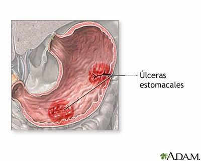 La úlcera peptídica, ¿qué es y cómo tratarla?