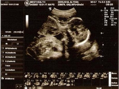 El tabaco en el tercer trimestre del embarazo reduce el peso del futuro bebé Nuevo método para determinar el peso del bebé