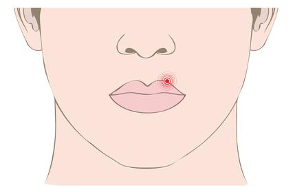 ¿ Cúales son los Síntomas del HERPES ? Herpes