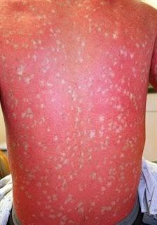 Hallan una mutación genética que es capaz de causar y curar una enfermedad rara Hallan una mutación genética que es capaz de causar y curar una enfermedad rara