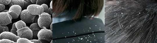 Cabello caspa fotos Cabello con caspa