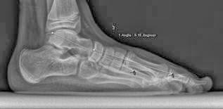 TRATAMIENTO DEL PIE PLANO DEL ADOLESCENTE TRATAMIENTO DEL PIE PLANO DEL ADOLESCENTE