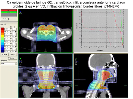 La radioterapia en el Cáncer de Cabeza y Cuello La radioterapia en el Cáncer de Cabeza y Cuello