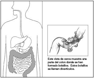 Enfermedad diverticular Ilustración del sistema digestivo resaltando el colon. A un lado hay una sección en primer plano del colon don divertículos o bolsillos.