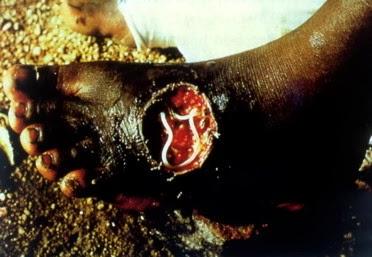 LOMBRIZ DE GUINEA O DRANCUCULIASIS ¡EXTRAÑOS PARÁSITOS QUE CONTROLAN TU MENTE¡