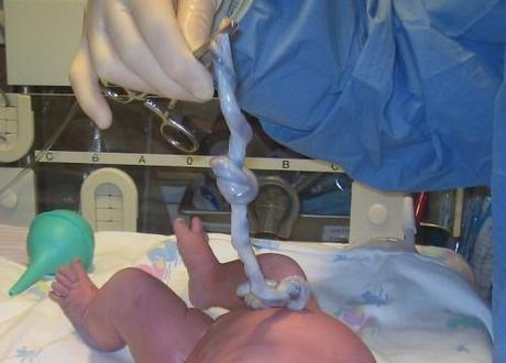Problemas con el cordón umbilical durante el embarazo Cordón umbilical
