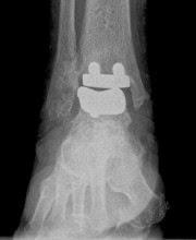 INDICACIONES DE LA PROTESIS DE TOBILLO INDICACIONES DE LA PROTESIS DE TOBILLO