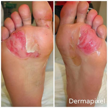 Lesiones cutáneas en corredores de larga distancia y cómo evitarlas Lesiones cutáneas en corredores de larga distancia y cómo evitarlas