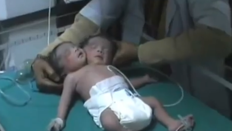 Nace en la India un bebé con dos cabezas