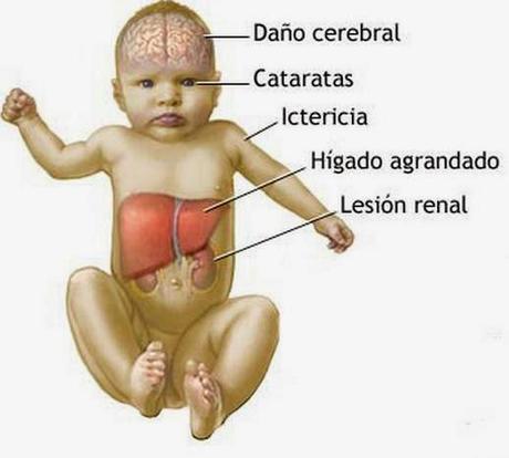 La intolerancia hereditaria a la galactosa, ¿qué es y cómo tratarla? La intolerancia hereditaria a la galactosa, ¿qué es y cómo tratarla?
