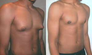 Hombres a los que les crecen los pechos (tetas) tras tomar el medicamento Risperdal Ginecomastia antipsicótico risperdal risperidona reacciones adversas efectos secundarios