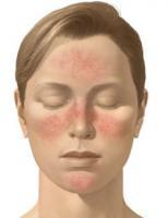 Hablemos de... Rosacea. imagenes para sonico