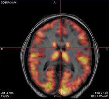 La neuroimagen detecta el Parkinson en pacientes con trastornos del sueño REM