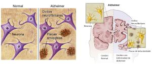 Suárez, Alzheimer y Radioterapia… alzheimer 8