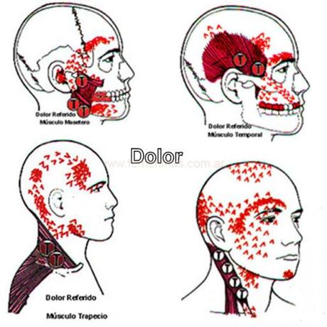 Siete de cada diez adultos presentan bruxismo, un 30% más que al inicio de la crisis bruxismoydolor