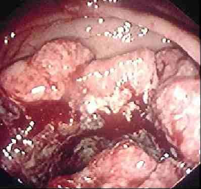 Identifican Molécula Responsable del Cáncer Colorrectal